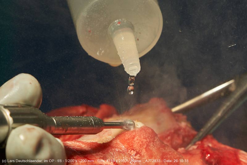 Knieoperation Knieoperation